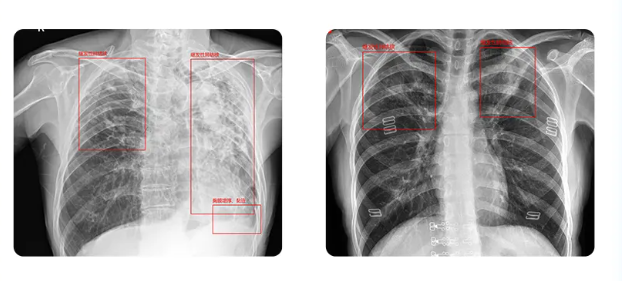 世界防治结核病日 | 宝润DR精准影像，让结核无处遁形